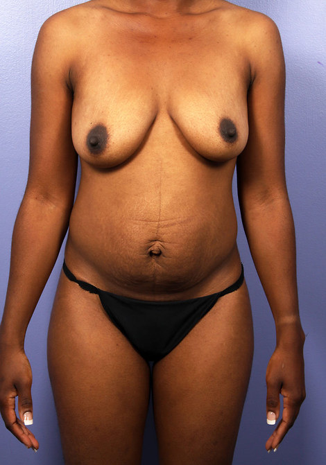 Liposuction before and after photo