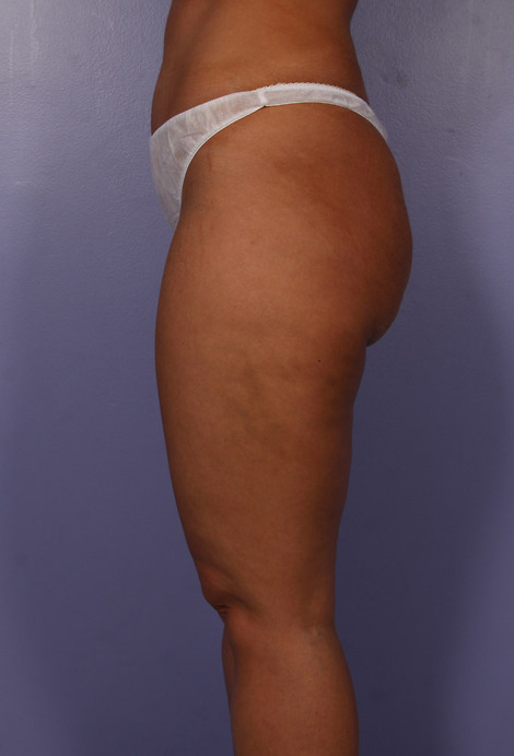 Liposuction before and after photo