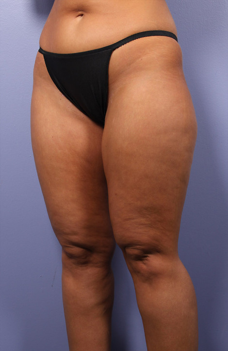 Liposuction before and after photo