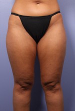 Liposuction Before and after photo