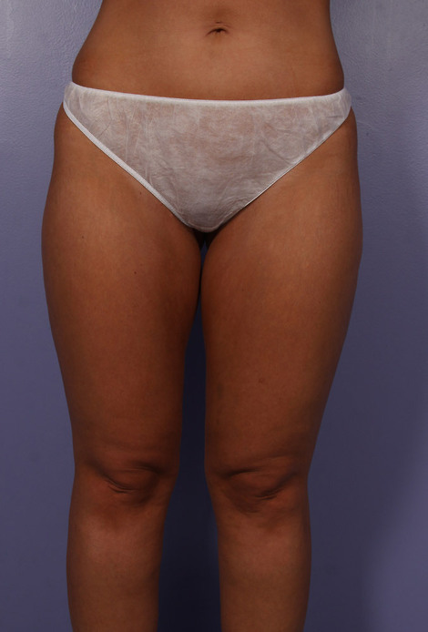 Liposuction before and after photo