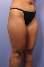 Liposuction Before and after photo