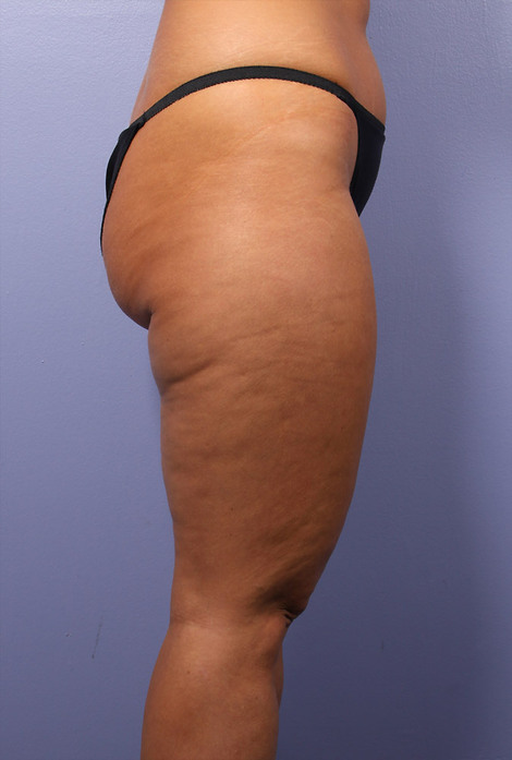 Liposuction before and after photo