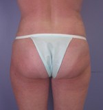 Liposuction Before and after photo