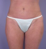 Liposuction Before and after photo