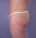 Liposuction Before and after photo