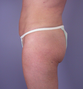 Liposuction before and after photo