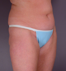 Liposuction before and after photo