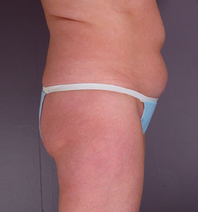 Liposuction before and after photo