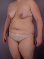 Liposuction Before and after photo