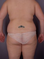 Liposuction Before and after photo