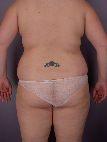 Liposuction before and after photo