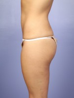 Liposuction Before and after photo