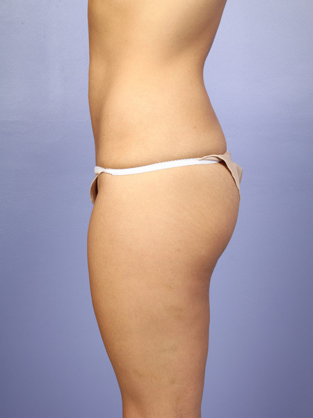 Liposuction before and after photo