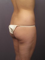 Liposuction Before and after photo