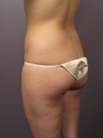 Liposuction Before and after photo