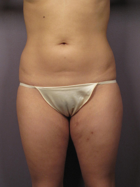 Liposuction before and after photo