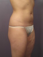 Liposuction Before and after photo