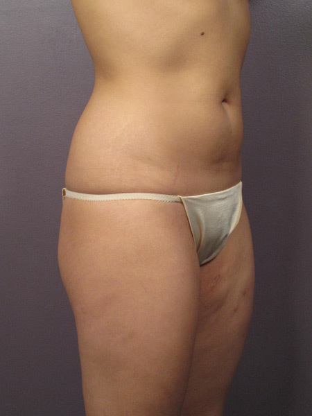 Liposuction before and after photo