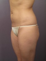 Liposuction Before and after photo