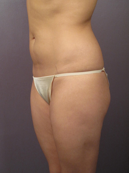 Liposuction before and after photo