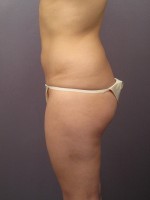 Liposuction Before and after photo