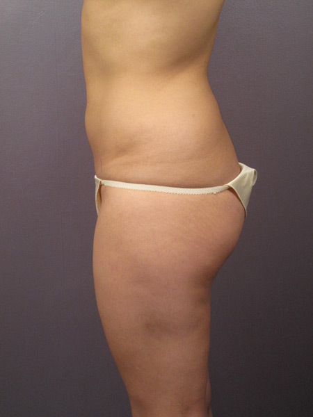 Liposuction before and after photo