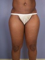 Liposuction Before and after photo