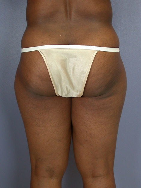 Liposuction before and after photo