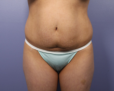 Liposuction before and after photo