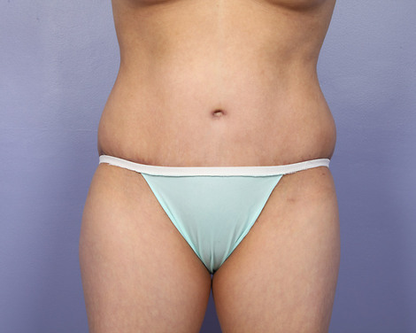 Liposuction before and after photo