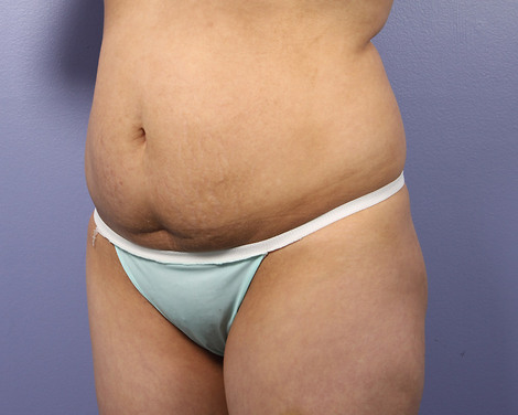 Liposuction before and after photo