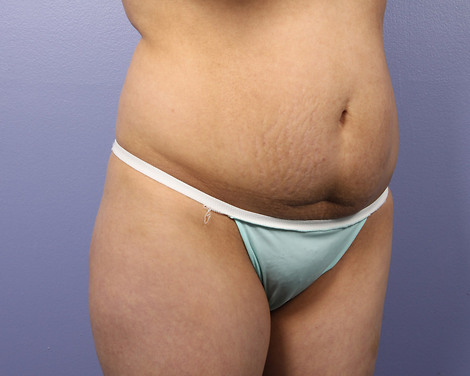 Liposuction before and after photo