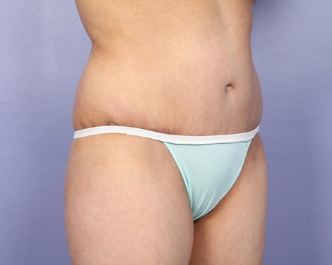 Liposuction before and after photo