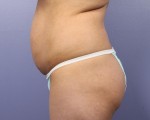 Liposuction Before and after photo