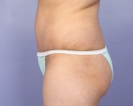 Liposuction Before and after photo