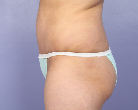 Liposuction before and after photo