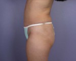 Liposuction Before and after photo