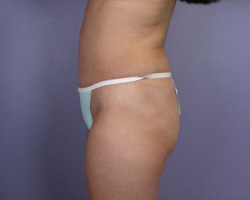 Liposuction before and after photo