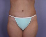 Liposuction Before and after photo