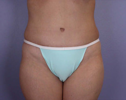 Liposuction before and after photo