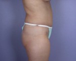 Liposuction Before and after photo