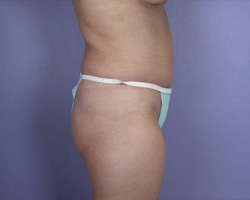 Liposuction before and after photo