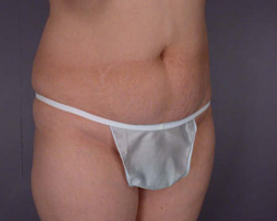 Liposuction before and after photo