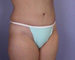 Liposuction Before and after photo