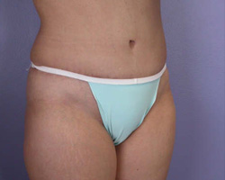 Liposuction before and after photo