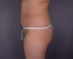 Liposuction Before and after photo