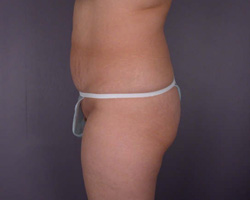 Liposuction before and after photo