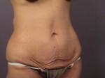 Liposuction Before and after photo