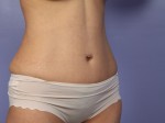 Liposuction Before and after photo